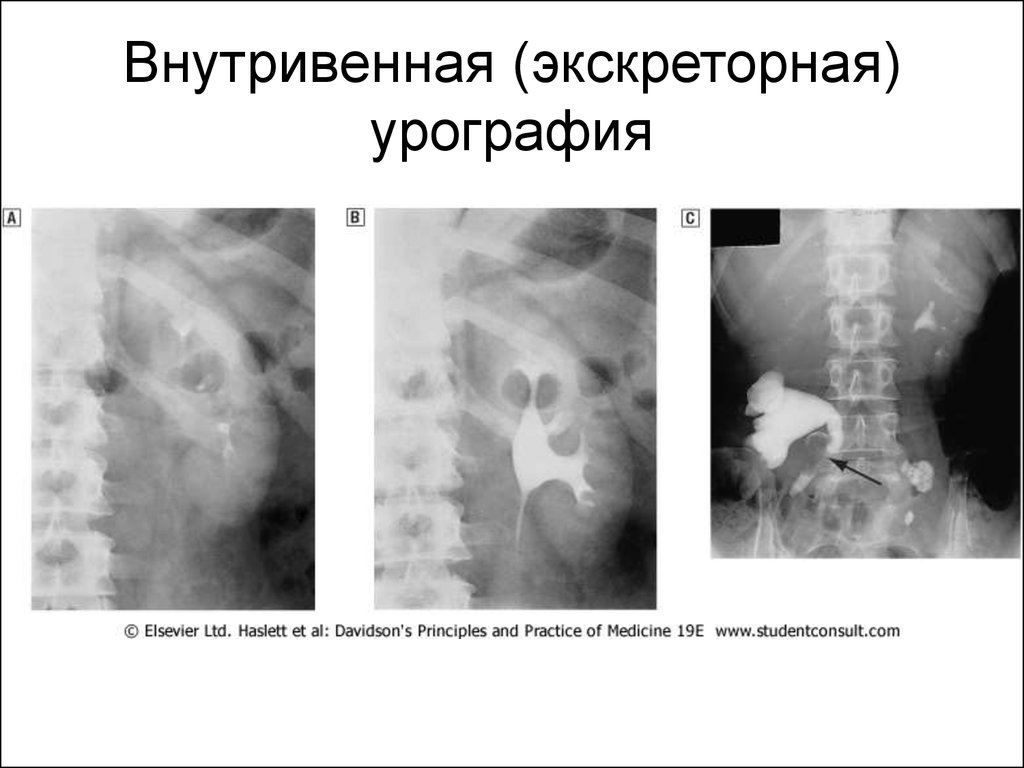 Внутривенная урография презентация