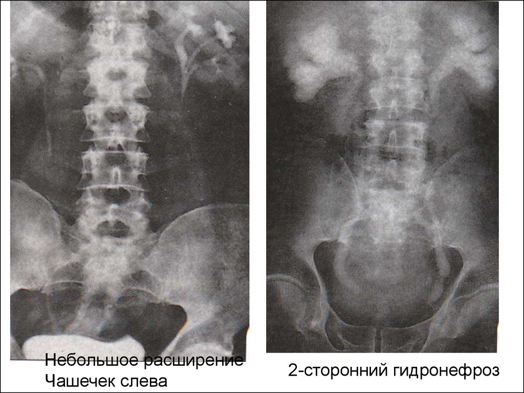 Расширение чашечек