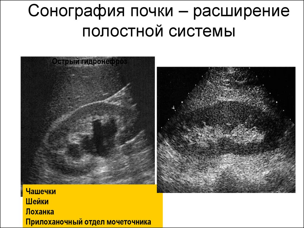 Расширение почки. Ультразвуковые исследования(сонография ) почек. УЗИ почек сонограмма. Расширение полостной системы УЗИ. Сонография показания.