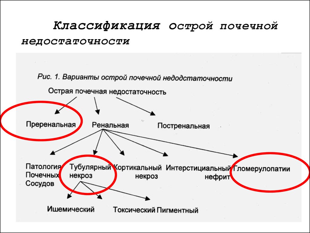 Дефицит вариант. Преренальная почечная недостаточность клиника. Классификация ОПН. Острая почечная недостаточность классификация. Классификация ОПН И ХПН.