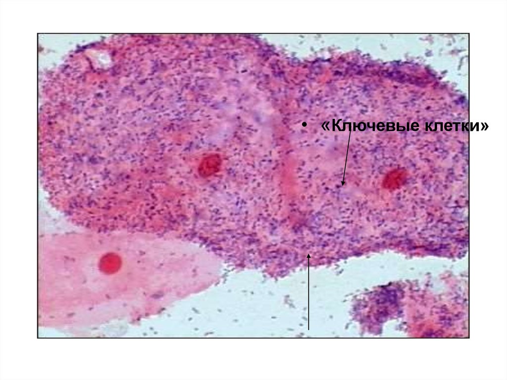Ключевые клетки. Бактериальный вагиноз ключевые клетки. Коккобациллярная микрофлора ключевые клетки. Ключевые клетки при бактериальном вагинозе.