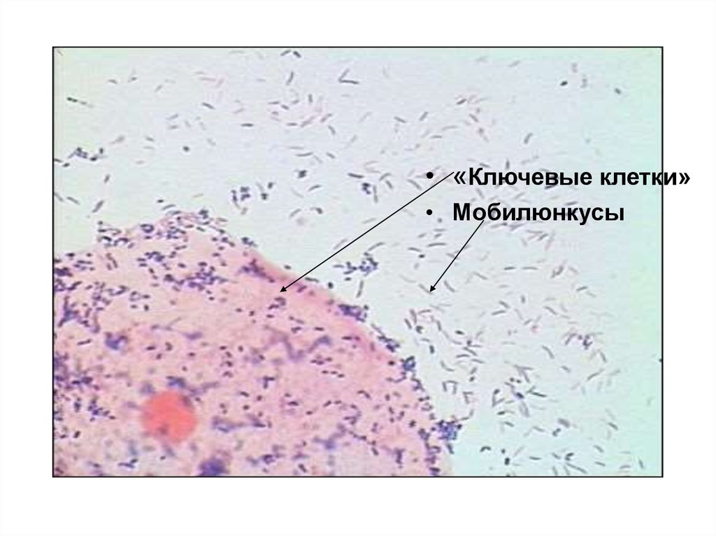 Баквагиноз что это. Бактериальный вагиноз мазок микроскопия. Ключевые клетки при бактериальном вагинозе. Бактериальный вагиноз микроскопопия.