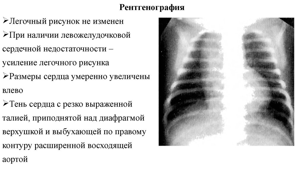 Усиление легочного рисунка