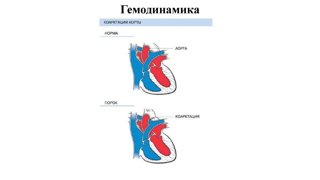 Пластика трикуспидального клапана