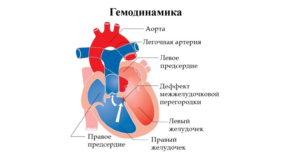 Дефект межжелудочковой перегородки гемодинамика схема