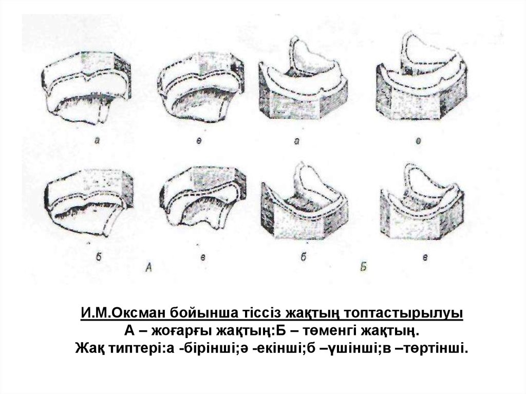 Беззубая челюсть по шредеру. Классификация Оксмана беззубых челюстей. Классификация атрофии альвеолярного отростка по Оксману. Классификация беззубых верхних и нижних челюстей по и.м. Оксману. Атрофия альвеолярного отростка по Оксману.