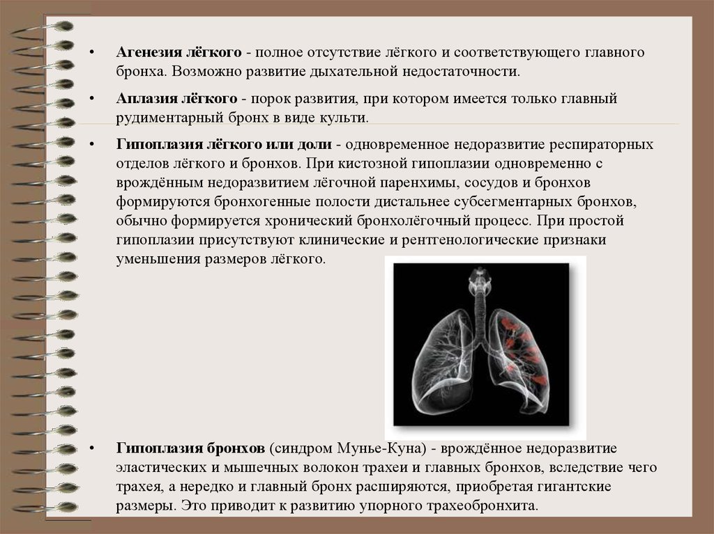 Гипоплазия легкого презентация