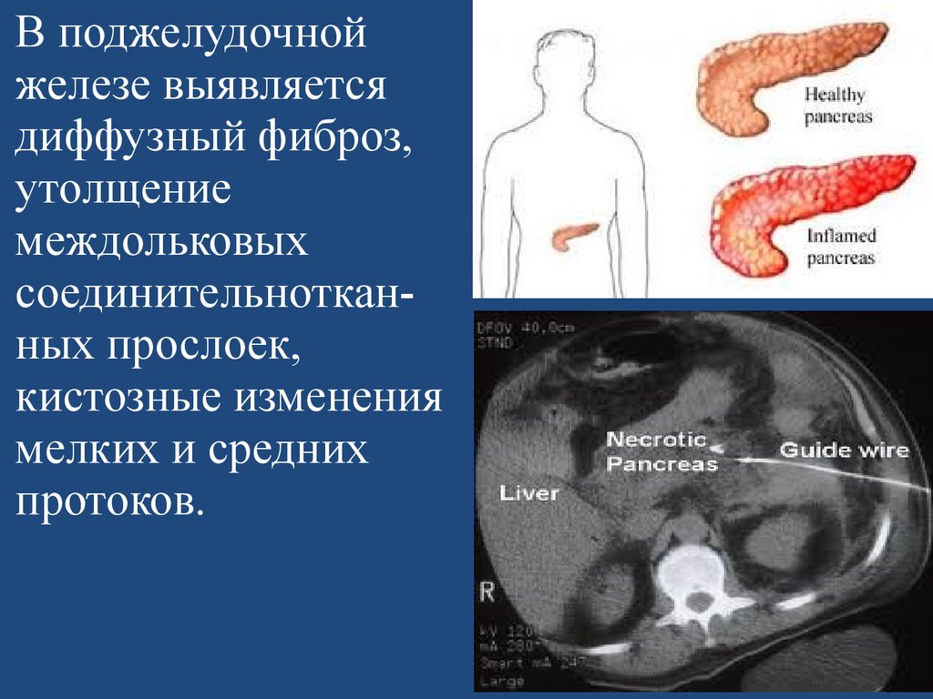 Структурные изменения поджелудочной. Паренхима-УЗИ поджелудочной железы. Диффузные изменения поджелудочной железы что это. Дефузное изменения поджелудочной железы. Диффузные изменения в поджелудочной железе.