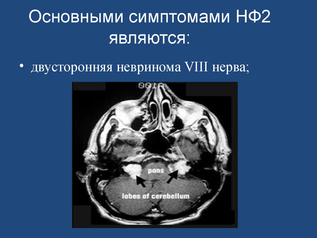 Viii черепного нерва. Невринома слухового нерва на кт. Двусторонняя невринома слухового нерва. Невринома VIII Черепного нерва.