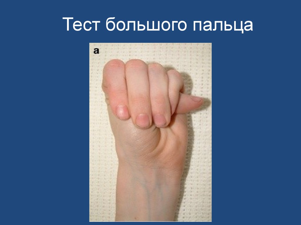 Тест большого пальца. Тест большой палец ладонь. Тест запястья и большого пальца. Тест большого пальца ДСТ.