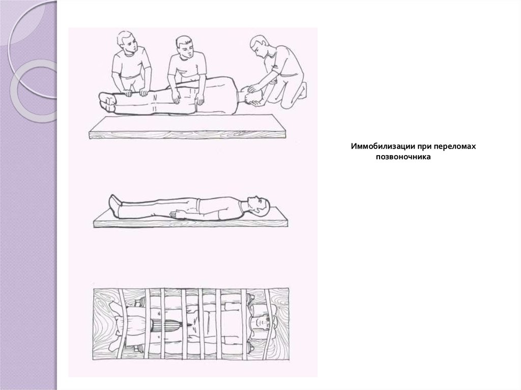 Иммобилизация при травмах позвоночника. Иммобилизация при переломе позвоночника. Как необходимо провести иммобилизацию позвоночника. Стол для ребенка с переломом позвоночника. Как необходимо провести иммобилизацию позвоночника сидя.
