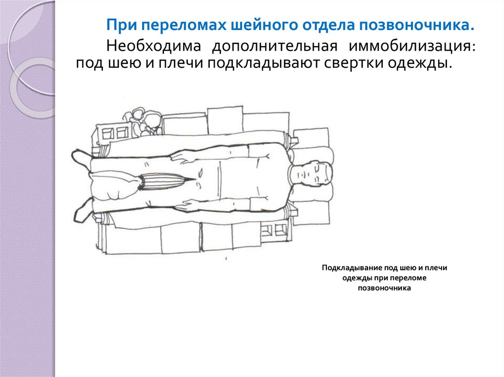 Травма шейного отдела позвоночника иммобилизация. Транспортная иммобилизация при переломе позвоночника. Иммобилизация при переломе шейного отдела позвоночника. Иммобилизация шейного отдела позвоночника. Диагностика перелома позвоночника на догоспитальном этапе.