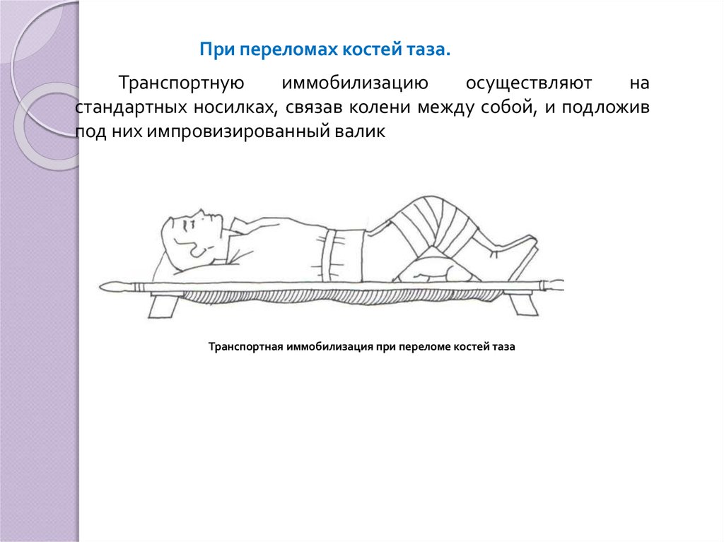 Перелом костей таза