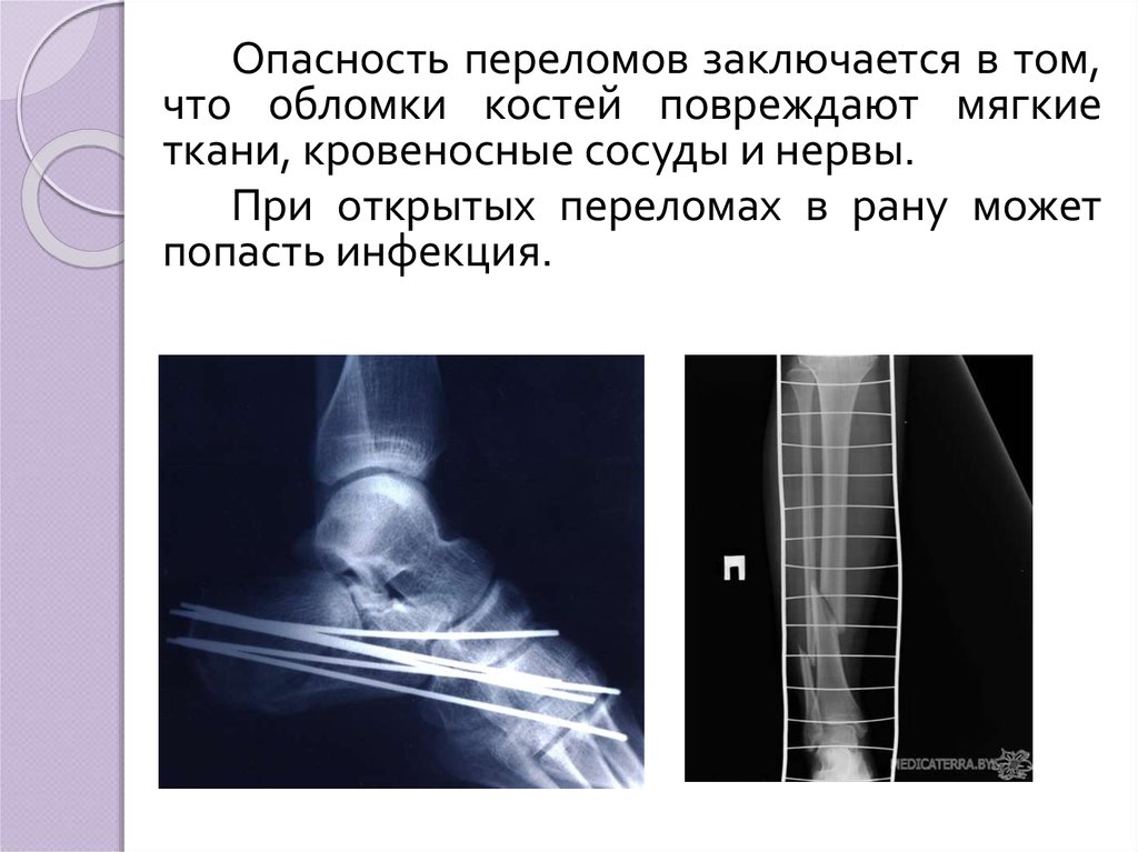 Наиболее опасные переломы