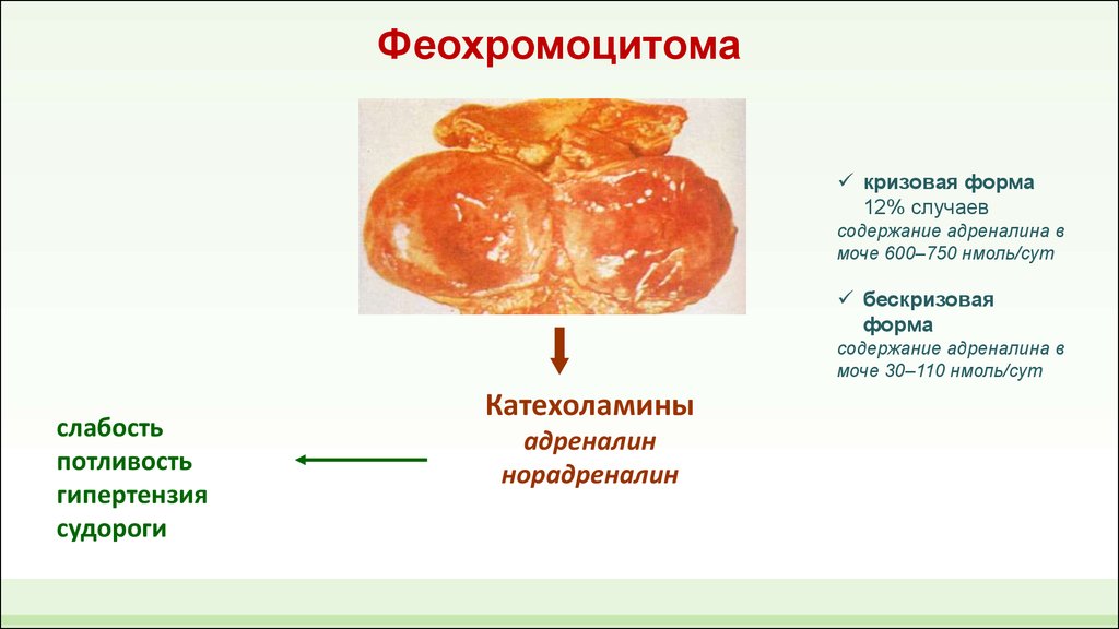 Феохромоцитома фото больных