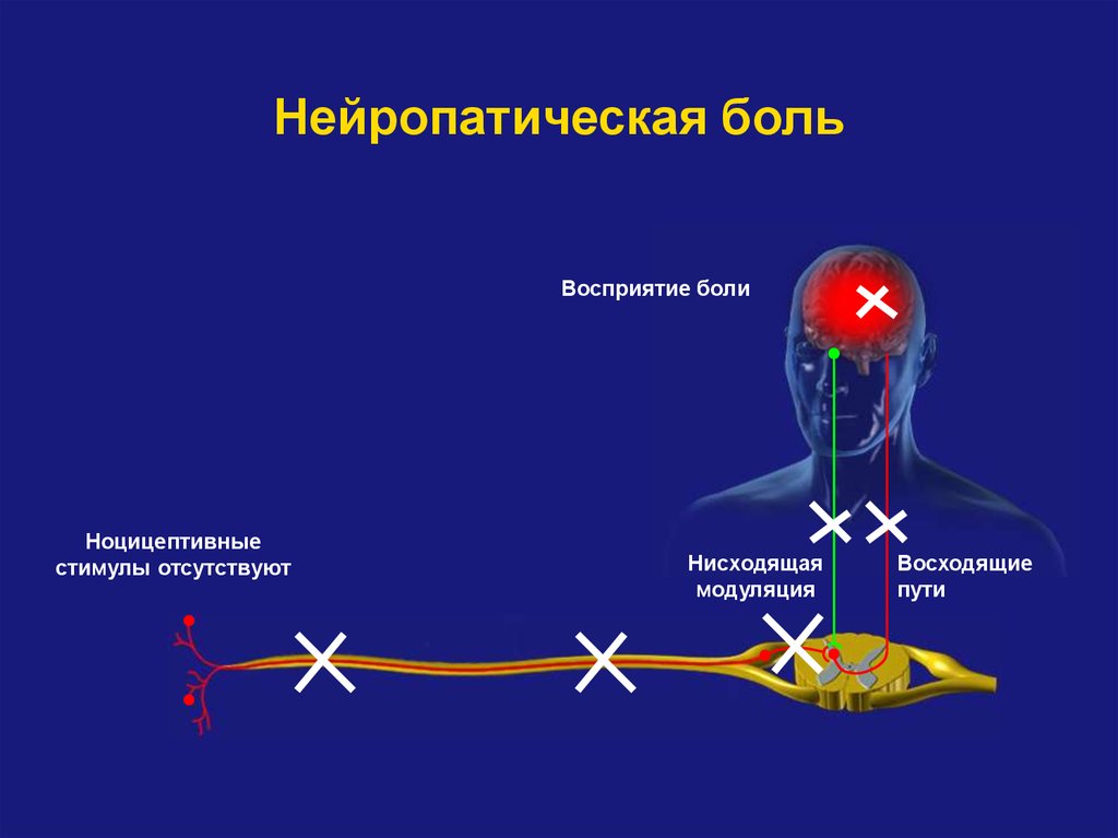 Чем лечить нейропатическую боль. Патогенез нейропатической боли. Механизм нейропатической боли. Схема нейропатической боли. Механизм развития нейропатической боли.