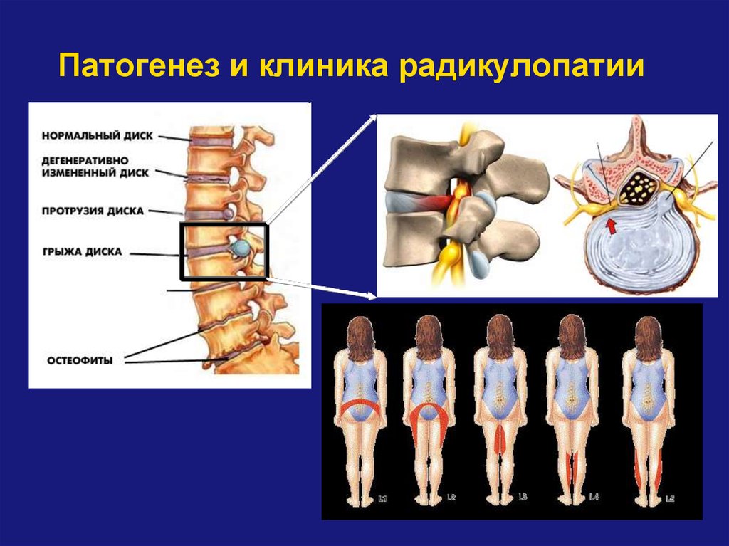 Радикулоишемия