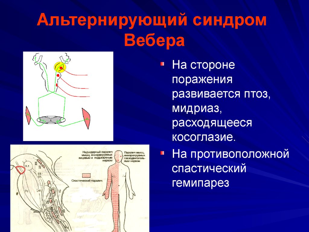 Альтернирующие синдромы схема