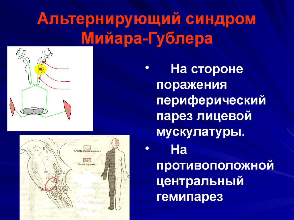 Синдром фовилля. Понтинные альтернирующие синдромы. Альтернирующий синдром Бриссо-Сикара. Мийяра Гюблера альтернирующий. Альтернирующий синдром Мийяра-Гублера.