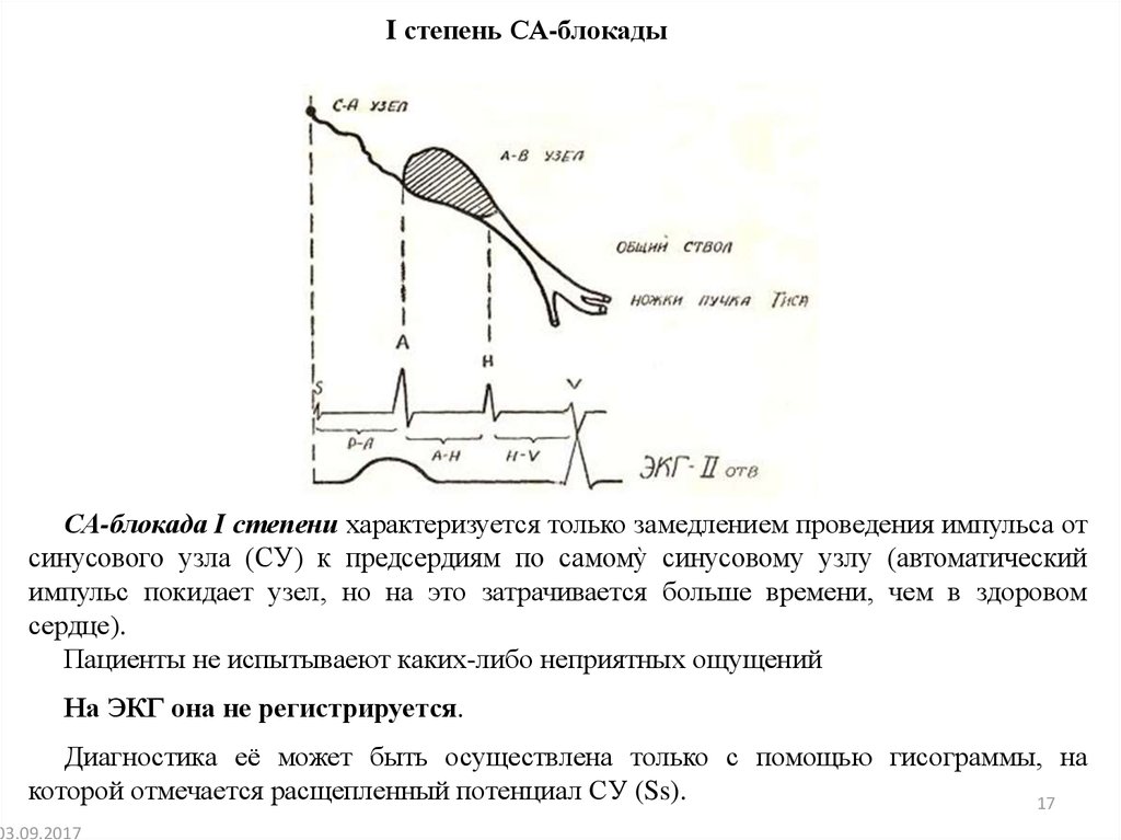 Замедление проводимости. Торможение проведения импульса. Замедление проведения по предсердиям. При возникновении импульса в синусовом узле на ЭКГ регистрируется. Синоатриальная блокада у спортсменов.