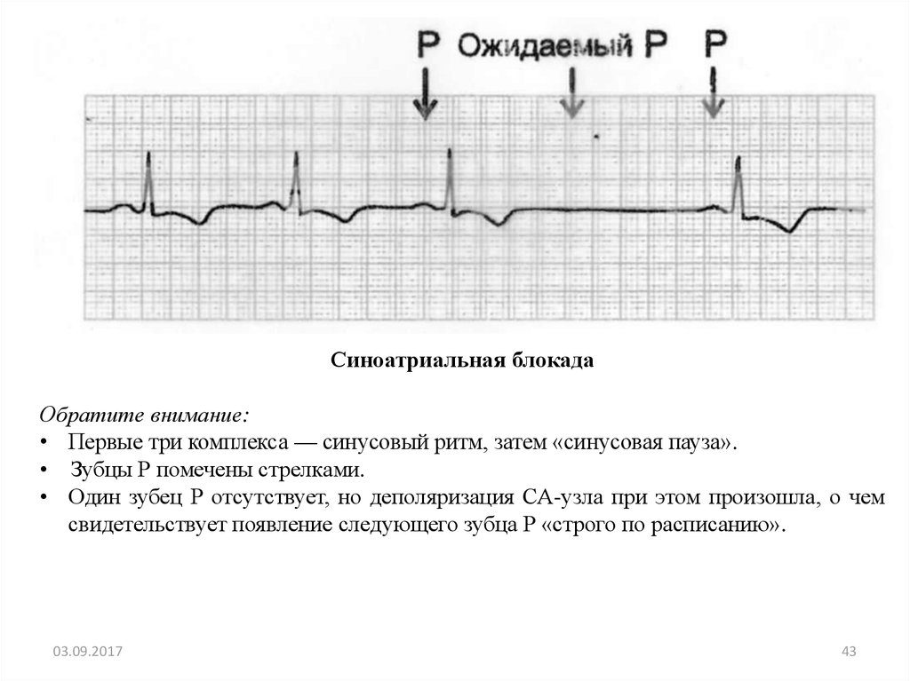 Признаки синоатриальной блокады. Синоатриальная блокада на ЭКГ. ЭКГ признаки синоатриальной блокады. Признаки са блокады 2 степени на ЭКГ. Синусовая пауза.