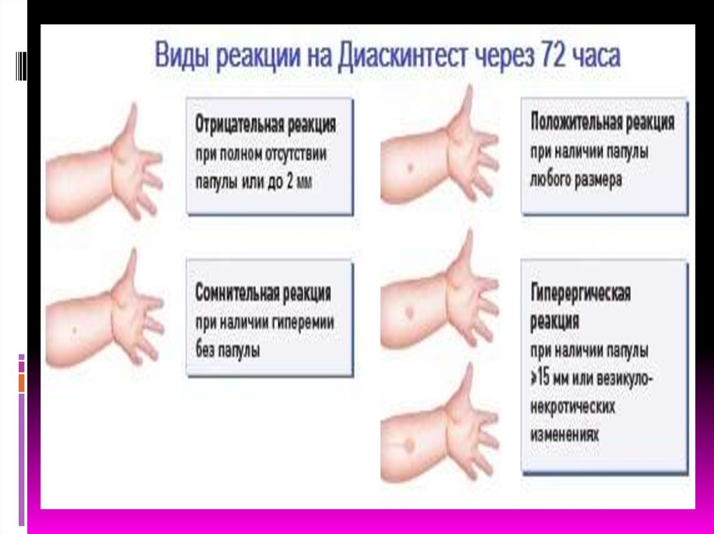 Через сколько дней проверяют манту у ребенка. Гиперемия диаскинтест. Папула диаскинтест манту. Диаскинтест папула 10 мм. Реакция манту и диаскинтест.