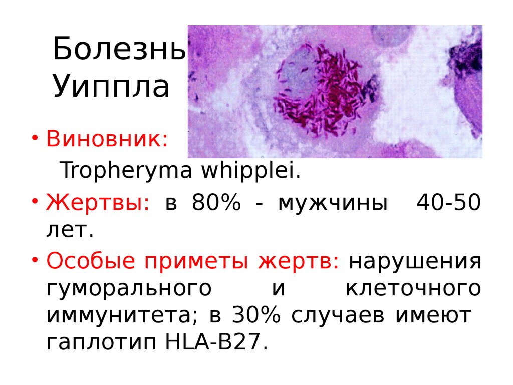 Випла. Гистологический признак болезни Уиппла. Болезнь Уиппла патоморфология. Болезнь Уиппла этиология.