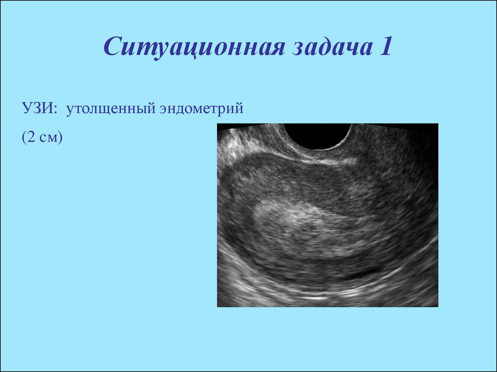 Низкий эндометрий. Эндометрия матки УЗИ гиперплазия эндометрия. Трехслойная структура эндометрия (УЗИ). Гиперплазия эндометрия на УЗИ. Измерение толщины эндометрия на УЗИ.