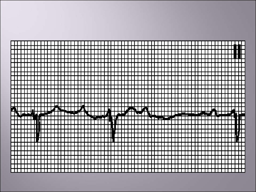 Выпадение комплекса QRS на ЭКГ. Мобитц 1 пропедевтика. АВ блокада 2 степени Мобитц 1. АВ блокада Мобитц 1.