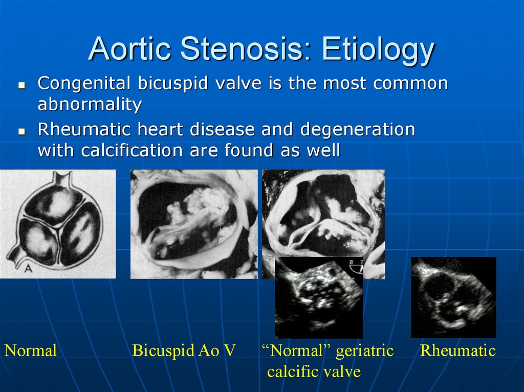 Aortic Stenosis Online Presentation