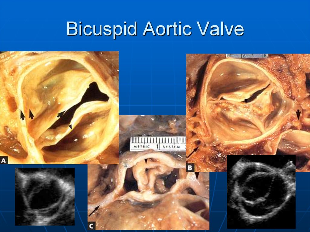 Aortic Stenosis Online Presentation