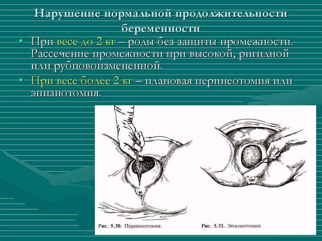 Нарушение беременности. Перинеотомия перинеоррафия. Рассечение промежности. Показания для рассечения промежности.