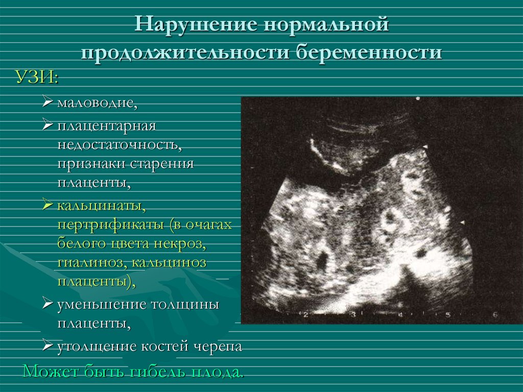 Нарушение беременности. УЗИ при плацентарной недостаточности. Кальцинаты в плаценте на 32 неделе беременности. Плацентарная недостаточность на УЗИ. Фетоплацентарная недостаточность на УЗИ.