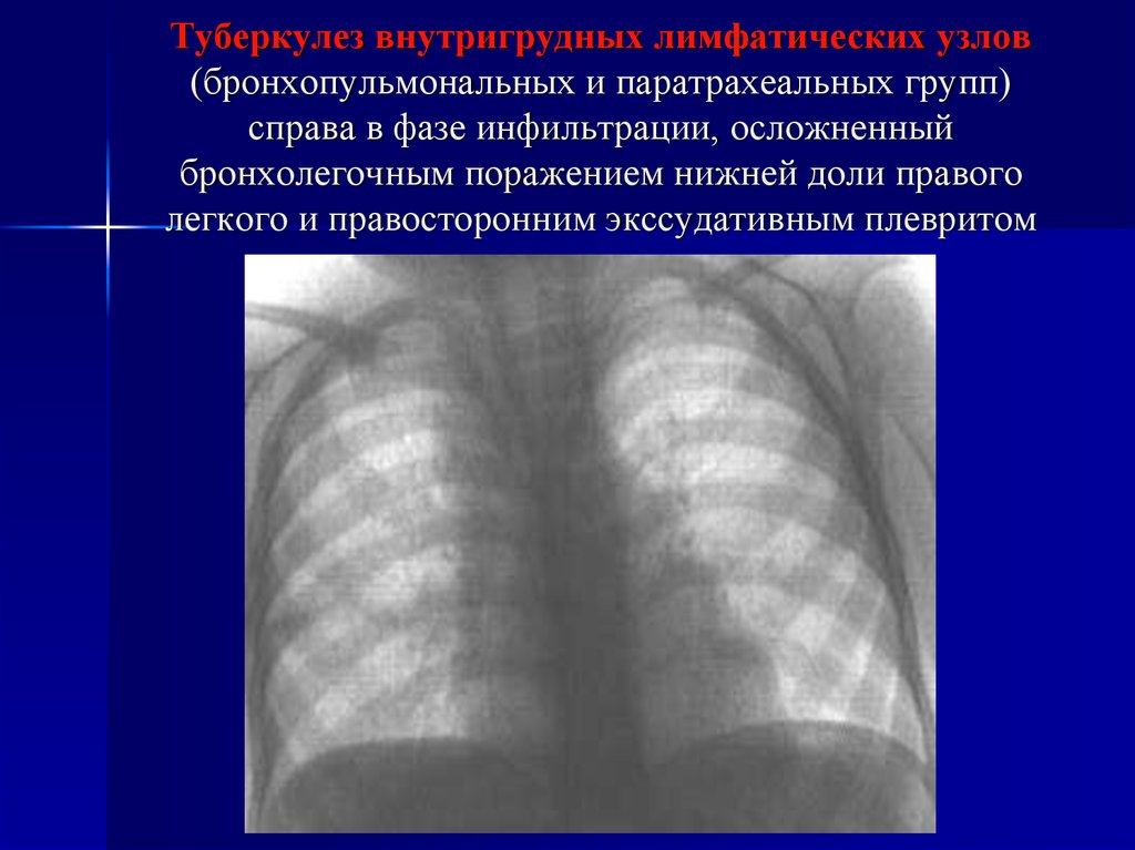 Уплотнение нижней доли легкого. Туберкулез лимфатических узлов рентгенограмма. Туберкулез внутригрудных лимфатических узлов в фазе инфильтрации. Туберкулез внутригрудных лимфатических узлов справа. Увеличение внутригрудных лимфоузлов рентген.