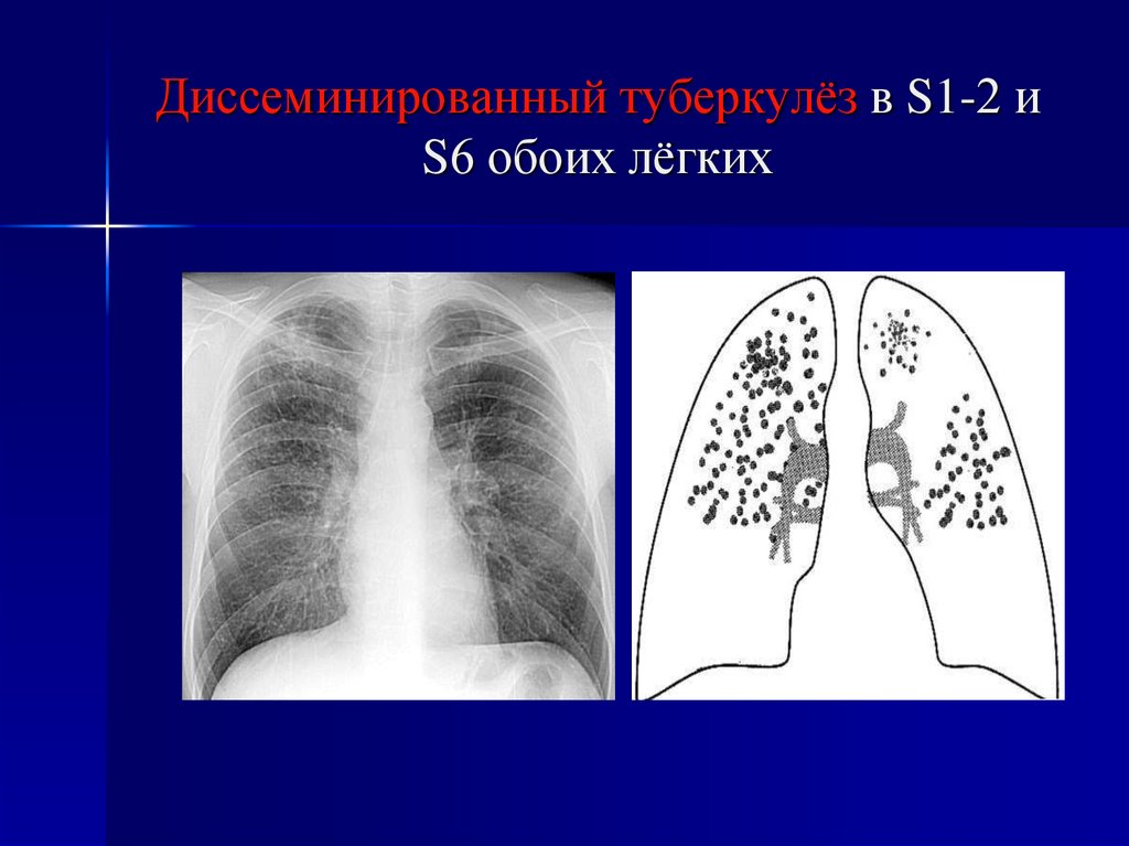 Диссеминированный туберкулез фаза инфильтрации. Острый диссеминированный туберкулез рентген. Милиарный диссеминированный туберкулез рентген. Подострый диссеминированный туберкулез легких рентген. Хронический диссеминированный туберкулез кт.