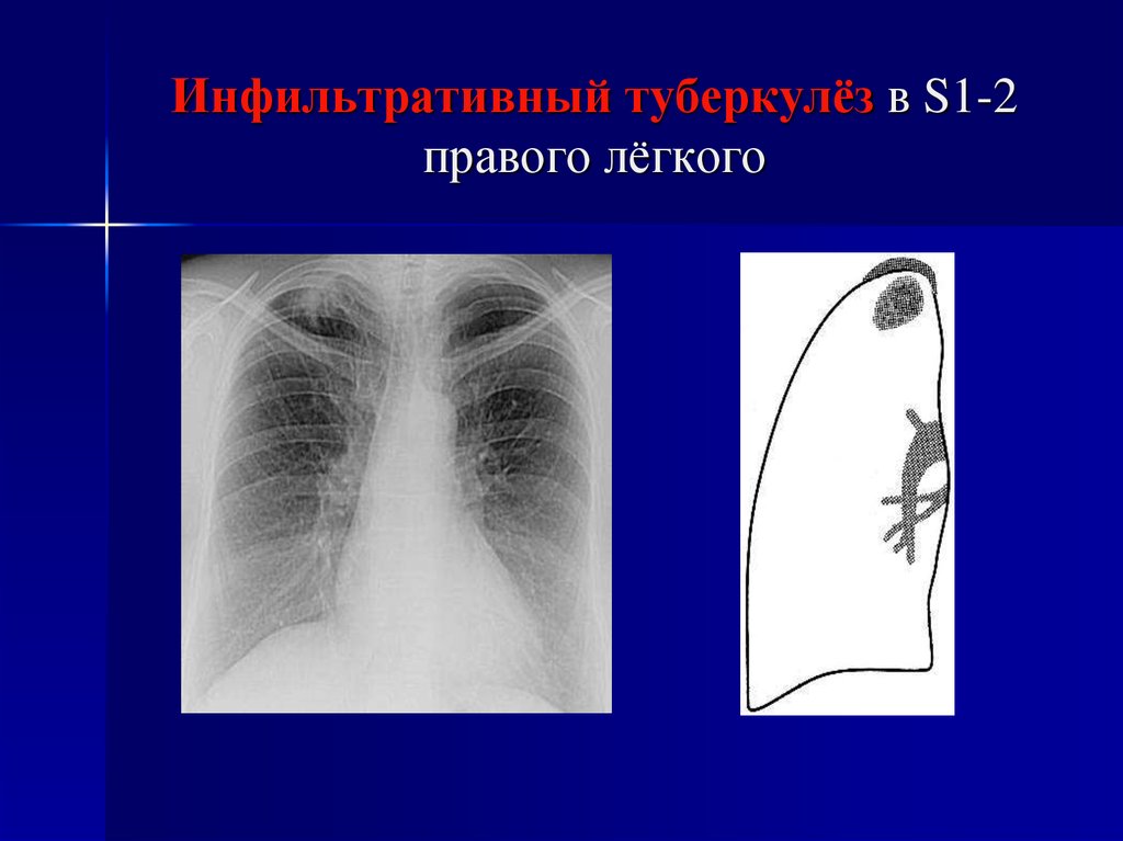 Инфильтративного в фазе распада. Инфильтративный туберкулез рентгенография. Очаговый туберкулез верхней доли правого легкого в фазе инфильтрации. Инфильтративный туберкулез s1 s2. Инфильтративный туберкулез легких s1 s2.