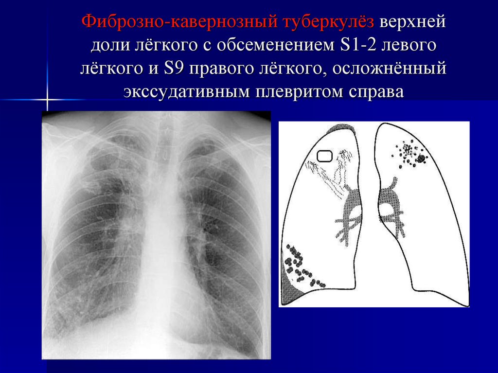 Инфильтративный туберкулез верхних долей легких. Инфильтративный туберкулез легких s1 s2. Инфильтративный туберкулез рентген. Фиброзно-кавернозный туберкулез рентген. Инфильтративный туберкулез легкого.