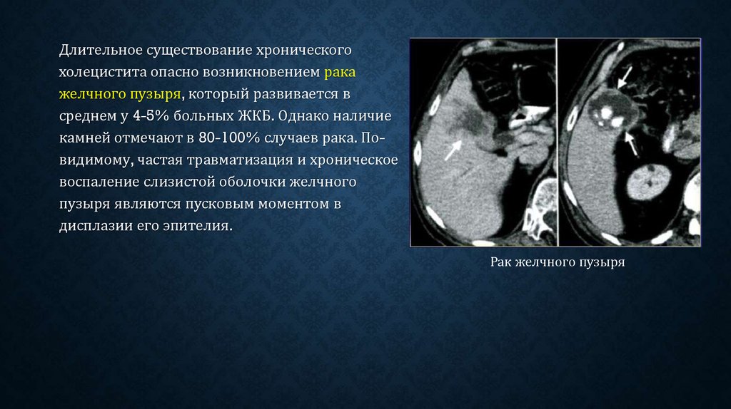 Рак желчного. Хронический калькулезный холецистит кт. Холедохолитиаз и калькулезный холецистит. Калькулезный холецистит кт. Хронического калькулезного холецистита хронического панкреатита.