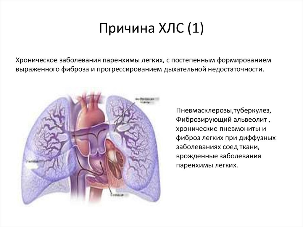 Хроническое легочное сердце презентация