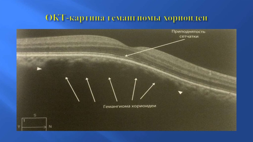 Оптическая томография. Меланома хориоидеи окт. Слои сетчатки на окт. Меланома сосудистой оболочки окт.