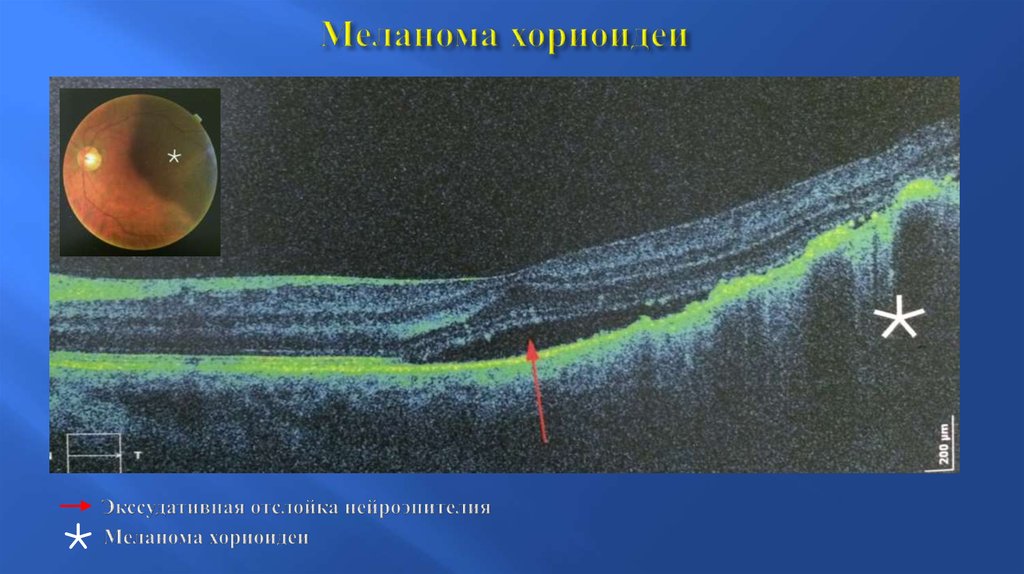 Фото меланома хориоидеи глаза