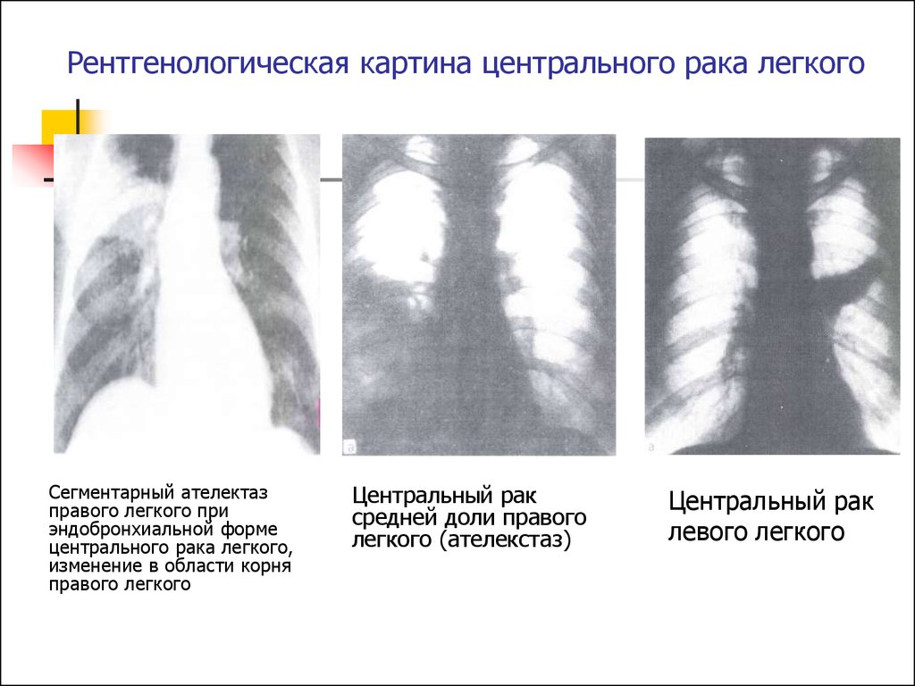 Центр легких. Рентгенологическая картина ателектаза средней доли правого легкого. Сегментарный ателектаз. Сегментарный ателектаз рентгенологическая картина. Центральное ЗНО верхней доли правого легкого.