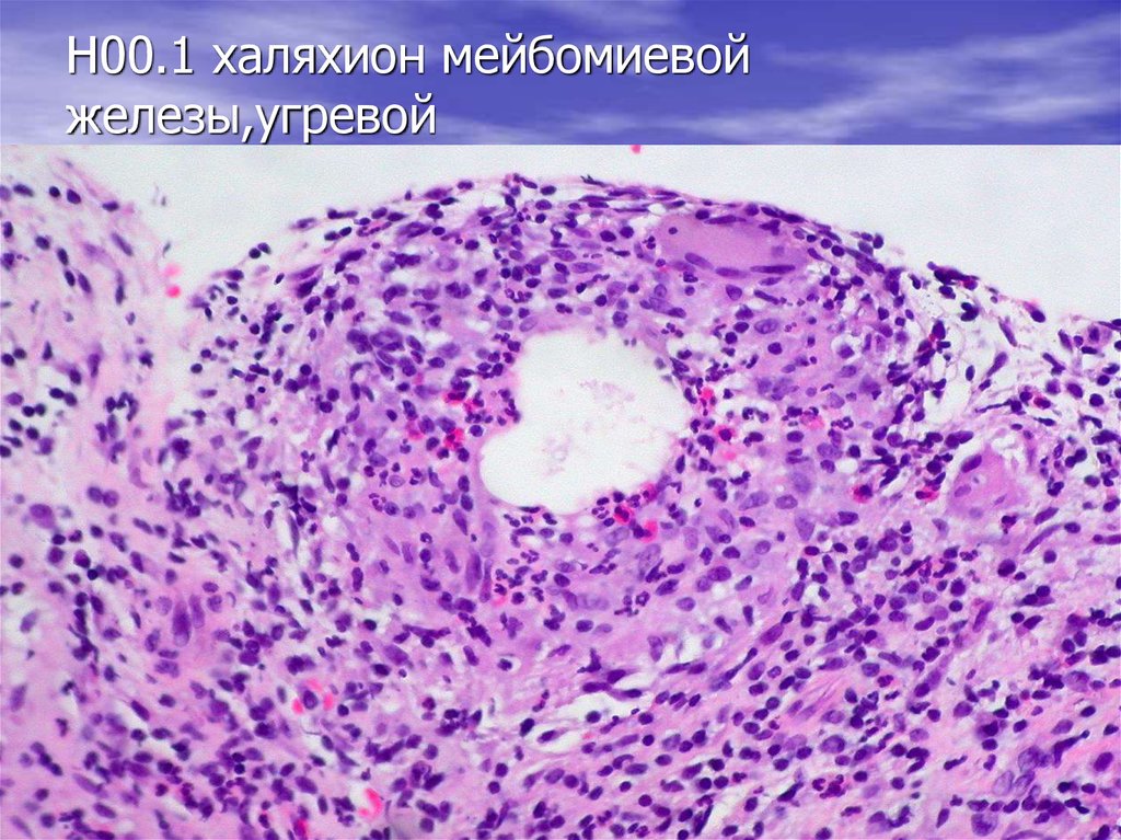 Н00.1 халяхион мейбомиевой железы,угревой