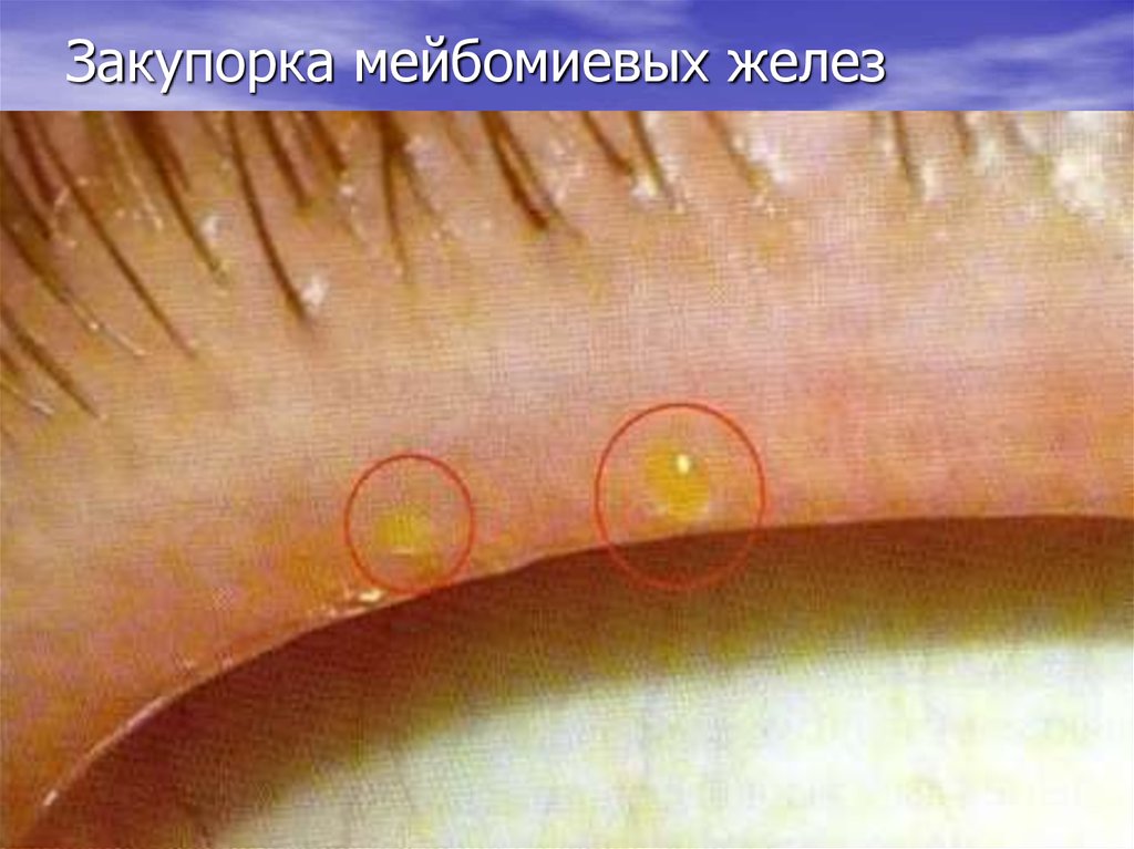 Закупорка мейбомиевых желез