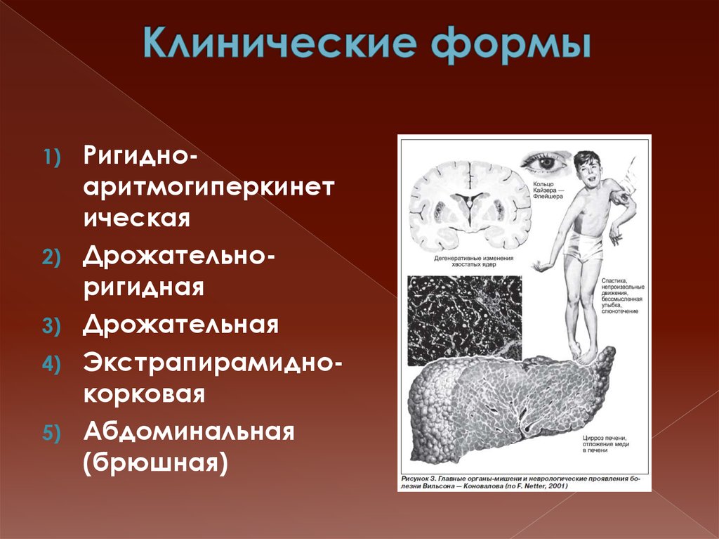 Болезнь вильсона коновалова клиническая картина