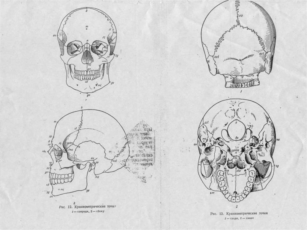 Варианты формы черепа. Аномальные формы черепа. Патологические формы черепа.