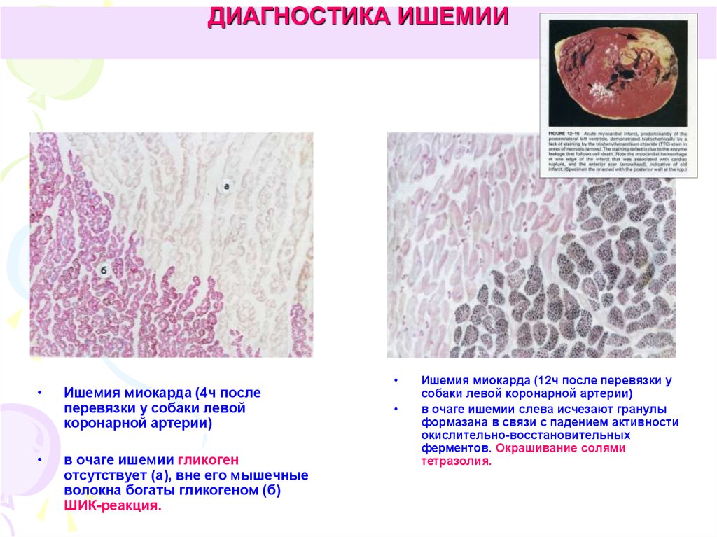 Дегенерация миокарда. Диагностика ишемии миокарда. Артериальное полнокровие микроскопическая характеристика.
