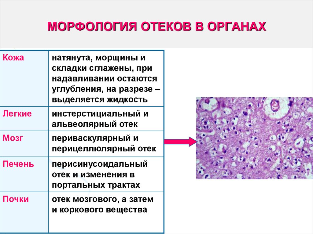 Микро изменение. Отек головного мозга морфология. Морфология отека легких. Отек легкого морфология. Отёк легких патанатомия.