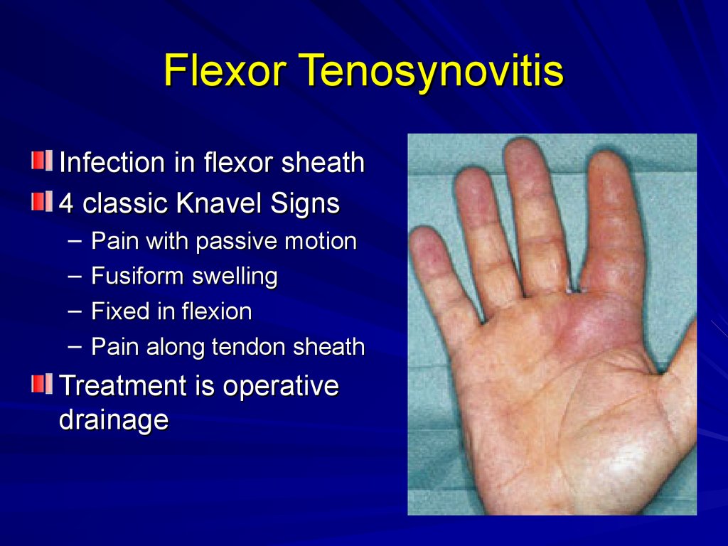 Rowers Should Look For These 5 Extensor Tenosynovitis