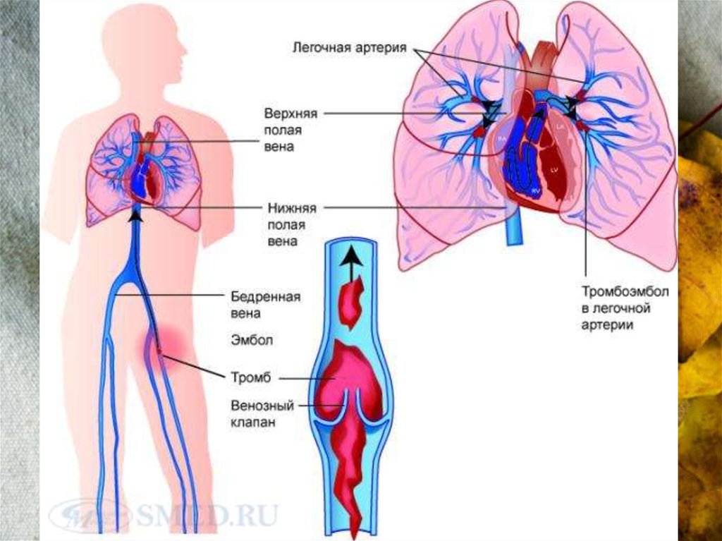 Тромбоэмболия артерии миокарда. Тромбоэмболия легочной артерии. Тромбофлебит легочной артерии. Тромб в легочной артерии.